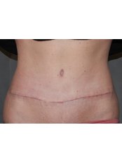 Lipoabdominoplasty - Harley Plastic Surgery
