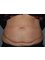 Harley Plastic Surgery - before tummy tuck and liposuction 