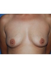 Breast Implants - Harley Plastic Surgery