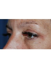 Eyelid surgery - Harley Plastic Surgery