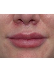 Lip Lift - Harley Plastic Surgery