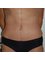 Harley Plastic Surgery - after post-bariatric tummy-tuck 