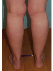 Knee Liposuction - Harley Plastic Surgery