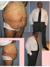 Tummy Tuck - Prof Dr Ashok Govila