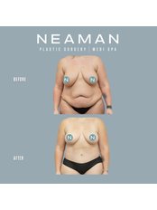 Mommy Makeover - Neaman Plastic Surgery & Medi Spa