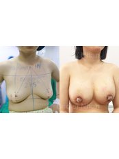 Breast Lift - Dr Nhan Ho Aesthetic and Plastic Surgery