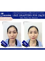 Fat Transfer - Dr. Duong Tran Van Clinic