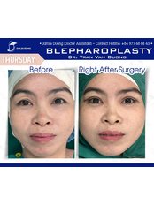 Asian Blepharoplasty - Dr. Duong Tran Van Clinic
