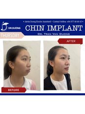 Chin Implant - Dr. Duong Tran Van Clinic