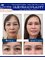 Dr. Duong Tran Van Clinic - Blepharoplasty 
