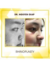 Rhinoplasty - Dr Nguyen Giap Aesthetic Surgery Center