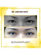 Eyelid Surgery - Dr Nguyen Giap Aesthetic Surgery Center
