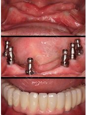 Dental Implants - EDC - Eminaj Dental Clinic
