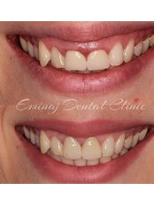 Dental Crowns - EDC - Eminaj Dental Clinic