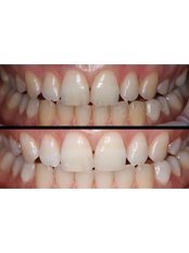 Teeth Whitening - EDC - Eminaj Dental Clinic