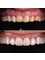 Dental Art Tirana - Zirconia crowns & gum correction 