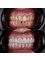 Dental Art Tirana - Emax veneers & crowns 