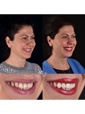 Teeth Whitening - Dental Art Tirana