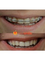 Orthodontics - Dental Clinic New Smile