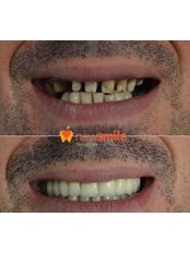 Dental Implants - Dental Clinic New Smile