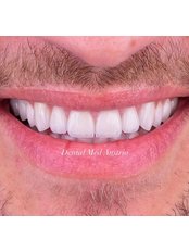 Veneers - Dental Med Austria
