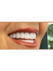 All-on-6 Dental Implants - Dental Med Austria