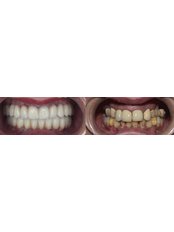 Full Mouth Rehabilitation - DentalCare ONE