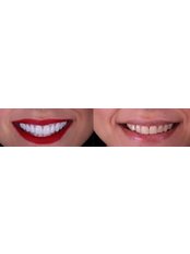 EMAX Dental Crowns - DentalCare ONE