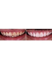 Zirconia Crown - DentalCare ONE
