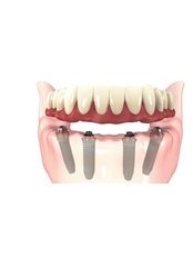 All-on-4 Dental Implants - Dilo Dental Center