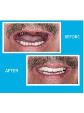 Smile Makeover - Galenus Dental Clinic