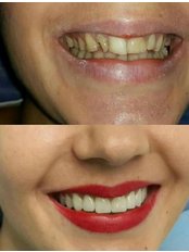 Zirconia Crown - Klinika Dentare Ledismile