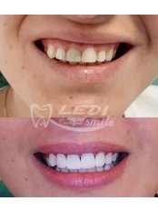 Veneers - Klinika Dentare Ledismile
