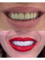 Smile Makeover - Klinika Dentare Ledismile