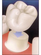 Dental Crowns - Klinika Dentare