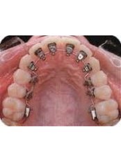 Lingual Braces - Orthodontic Clinic 