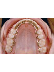 Incognito™ Braces - Orthodontic Clinic 