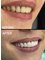 Sanart Dental Studio - New Smile . Maxillary rehabilitation with Zirconia crowns . 