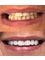 Sanart Dental Studio - Full mouth rehabilitation with Zirconia Crowns. New smile / Whitening teeth  