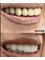 Sanart Dental Studio - Full mouth rehabilitation with Zirconia Crowns.  