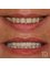 Toronto Dental Clinic Albania - Smile makeover emax veneers 