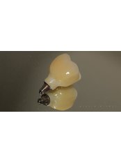 Dental Implants - Toronto Dental Clinic Albania