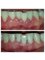 Toronto Dental Clinic Albania - Root planning - Deep dental cleaning  