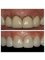 Toronto Dental Clinic Albania - Emax Crowns 