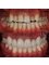 Toronto Dental Clinic Albania - emax crowns on upper 12 teeth  