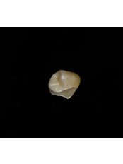 Porcelain Inlay or Onlay - ND ,  Dental Esthetics & Implants