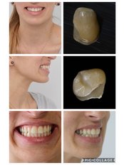 Porcelain Veneers - ND ,  Dental Esthetics & Implants