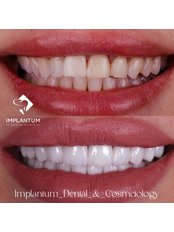 Porcelain Veneers - Implantum Dental Clinic