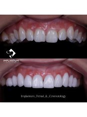 Veneers - Implantum Dental Clinic