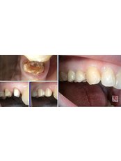 Zirconia Crown - VB Dental Clinic